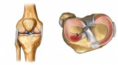 Artroskopik menisk yırtıqların bərpası