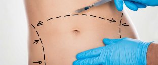 Qarın germe Əməliyyatı: abdominoplastika