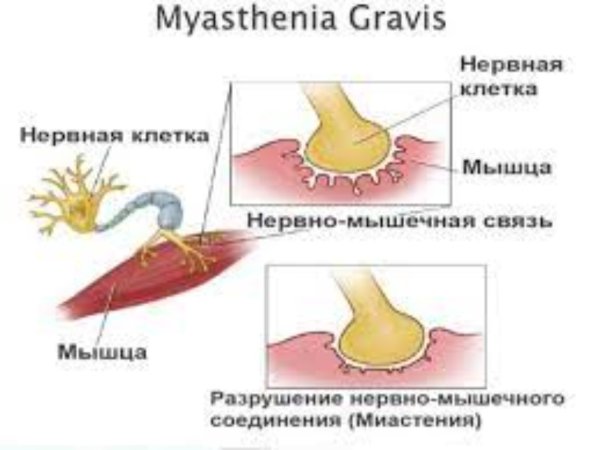 Miasteniya qravis səbəbi ilə timus cərrahiyyəsi