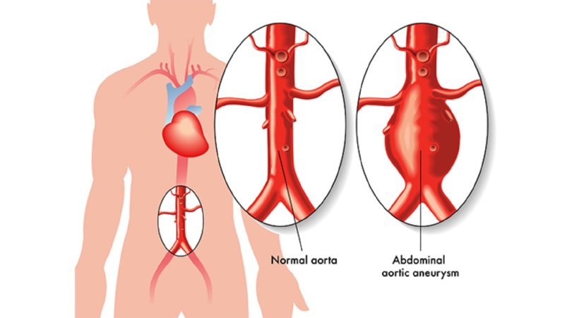 Aorta anevrizması cərrahiyyəsi: həyat xilasedici prosedur