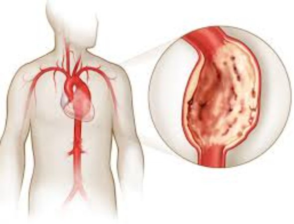 Arterial və venoz anevrizmalar