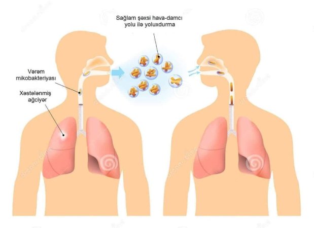 Allergik ağciyər xəstəlikləri haqqında